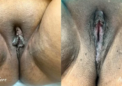 labiaplasty before and after photo by mona hardas md cosmetic gynecology in flint mi