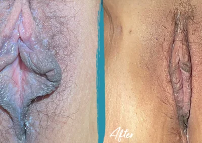labiaplasty before and after photo by mona hardas md cosmetic gynecology in flint mi