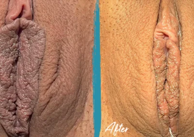 labiaplasty before and after photo by mona hardas md cosmetic gynecology in flint mi