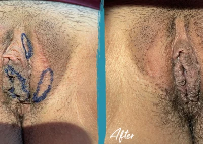 labiaplasty before and after photo by mona hardas md cosmetic gynecology in flint mi