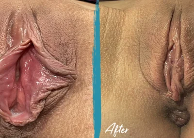 labiaplasty before and after photo by mona hardas md cosmetic gynecology in flint mi