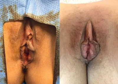 labiaplasty before and after photo by mona hardas md cosmetic gynecology in flint mi