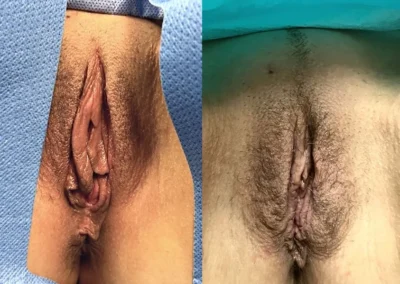 labiaplasty before and after photo by mona hardas md cosmetic gynecology in flint mi