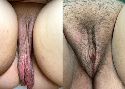 labiaplasty before and after photo by mona hardas md cosmetic gynecology in flint mi