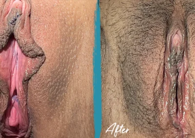 labiaplasty before and after photo by mona hardas md cosmetic gynecology in flint mi