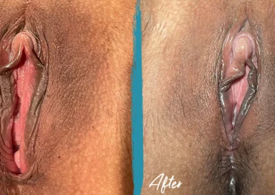 vaginoplasty before and after photo by mona hardas md cosmetic gynecology in flint mi