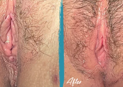 vaginoplasty before and after photo by mona hardas md cosmetic gynecology in flint mi