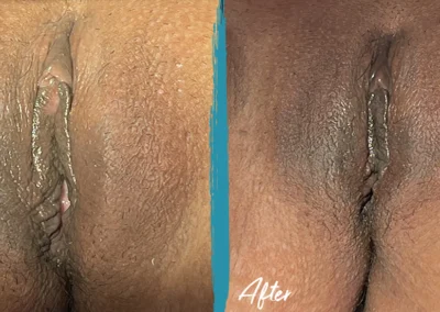 vaginoplasty before and after photo by mona hardas md cosmetic gynecology in flint mi