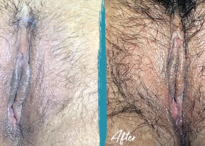 vaginoplasty before and after photo by mona hardas md cosmetic gynecology in flint mi