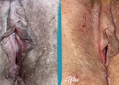 vaginoplasty before and after photo by mona hardas md cosmetic gynecology in flint mi