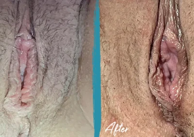 vaginoplasty before and after photo by mona hardas md cosmetic gynecology in flint mi