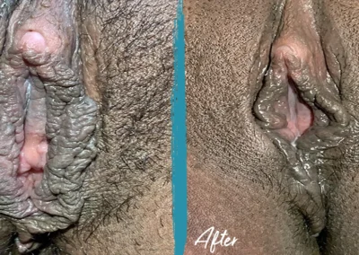 vaginoplasty before and after photo by mona hardas md cosmetic gynecology in flint mi