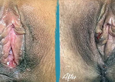 vaginoplasty before and after photo by mona hardas md cosmetic gynecology in flint mi