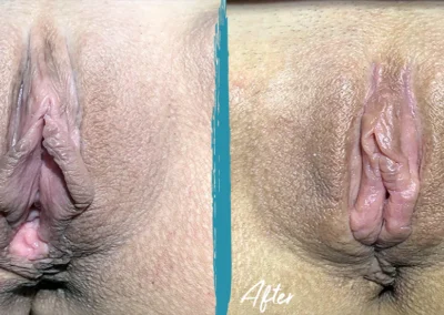 vaginoplasty before and after photo by mona hardas md cosmetic gynecology in flint mi