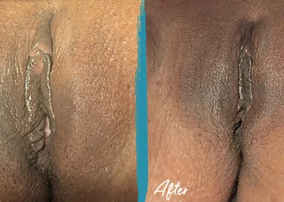 vaginoplasty before and after photo by mona hardas md cosmetic gynecology in flint mi