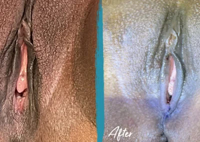 vaginoplasty before and after photo by mona hardas md cosmetic gynecology in flint mi