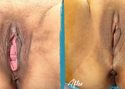 vaginoplasty before and after photo by mona hardas md cosmetic gynecology in flint mi