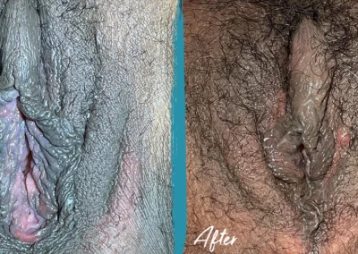 vaginoplasty before and after photo by mona hardas md cosmetic gynecology in flint mi