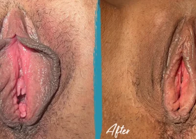vaginoplasty before and after photo by mona hardas md cosmetic gynecology in flint mi