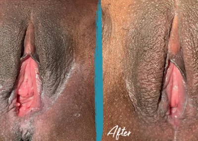 vaginoplasty before and after photo by mona hardas md cosmetic gynecology in flint mi