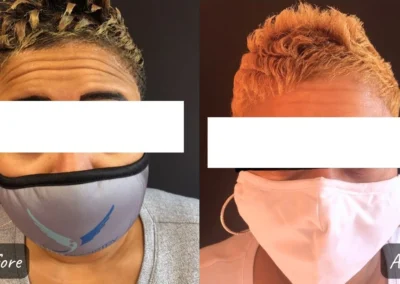 botox and fillers before and after photo by mona hardas md cosmetic gynecology in flint mi