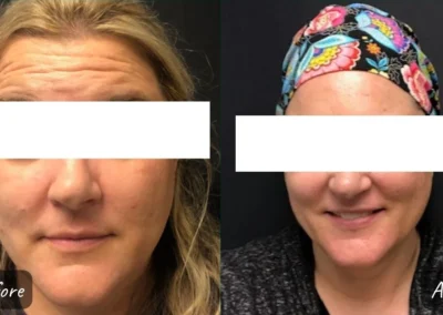 botox and fillers before and after photo by mona hardas md cosmetic gynecology in flint mi