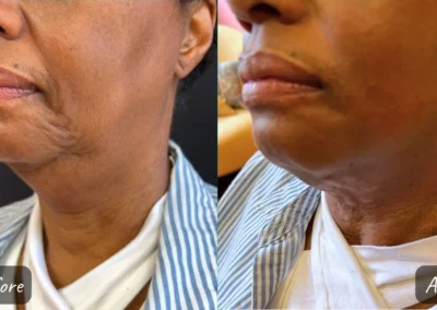 botox and fillers before and after photo by mona hardas md cosmetic gynecology in flint mi