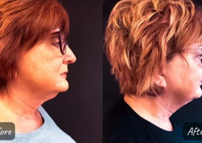 botox and fillers before and after photo by mona hardas md cosmetic gynecology in flint mi