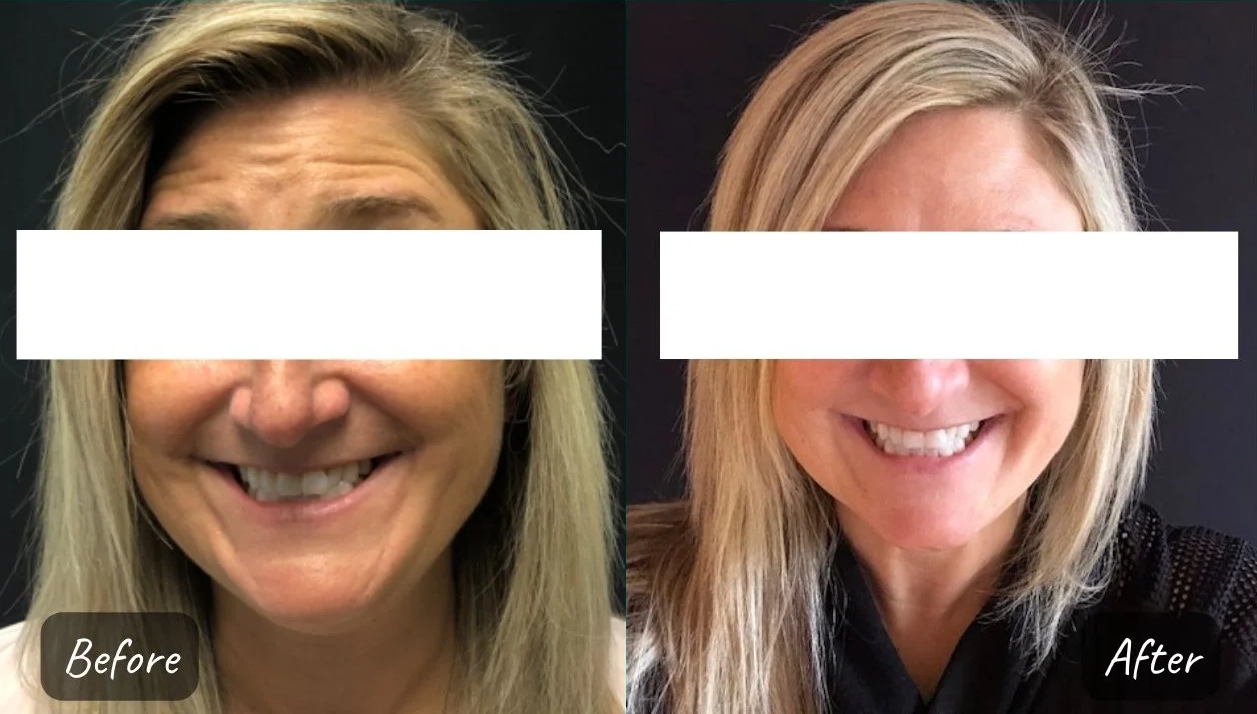 botox and fillers before and after photo by mona hardas md cosmetic gynecology in flint mi botox and fillers before and after photo by mona hardas md cosmetic gynecology in flint mi