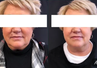botox and fillers before and after photo by mona hardas md cosmetic gynecology in flint mi
