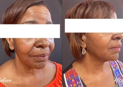 botox and fillers before and after photo by mona hardas md cosmetic gynecology in flint mi
