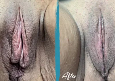 clitoral hood reduction before and after photo by mona hardas md cosmetic gynecology in flint mi