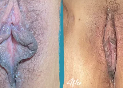 clitoral hood reduction before and after photo by mona hardas md cosmetic gynecology in flint mi