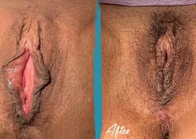 clitoral hood reduction before and after photo by mona hardas md cosmetic gynecology in flint mi