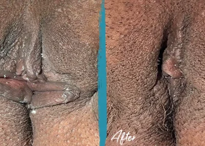 clitoral hood reduction before and after photo by mona hardas md cosmetic gynecology in flint mi