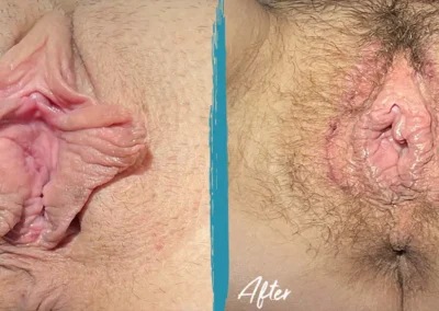 clitoral hood reduction before and after photo by mona hardas md cosmetic gynecology in flint mi