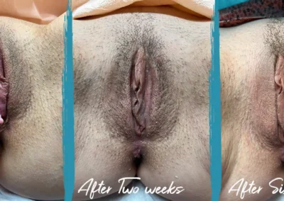 perineoplasty before and after photo by mona hardas md cosmetic gynecology in flint mi