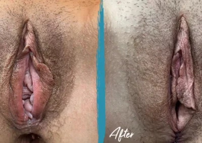 perineoplasty before and after photo by mona hardas md cosmetic gynecology in flint mi
