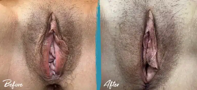 perineoplasty before and after photo by mona hardas md cosmetic gynecology in flint mi perineoplasty before and after photo by mona hardas md cosmetic gynecology in flint mi