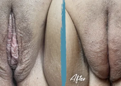 vaginal fat transfer before and after photo by mona hardas md cosmetic gynecology in flint mi