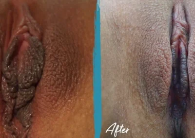 vaginal fat transfer before and after photo by mona hardas md cosmetic gynecology in flint mi