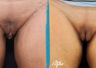 vaginal fat transfer before and after photo by mona hardas md cosmetic gynecology in flint mi