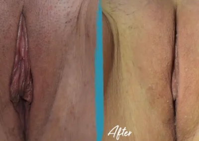 vaginal fat transfer before and after photo by mona hardas md cosmetic gynecology in flint mi
