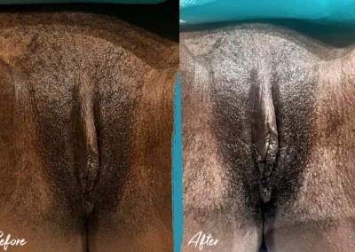 vaginal fat transfer before and after photo by mona hardas md cosmetic gynecology in flint mi
