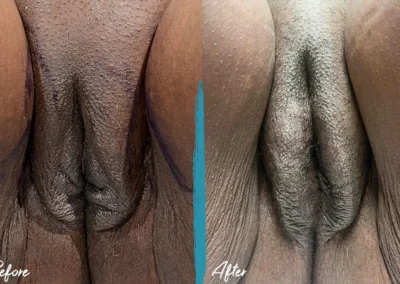 vaginal fat transfer before and after photo by mona hardas md cosmetic gynecology in flint mi
