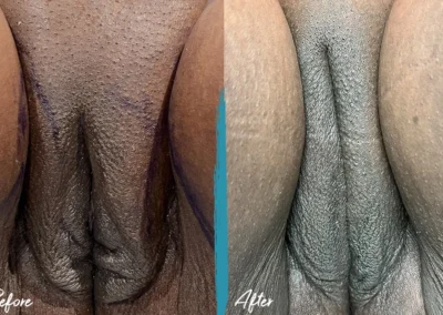 vaginal fat transfer before and after photo by mona hardas md cosmetic gynecology in flint mi