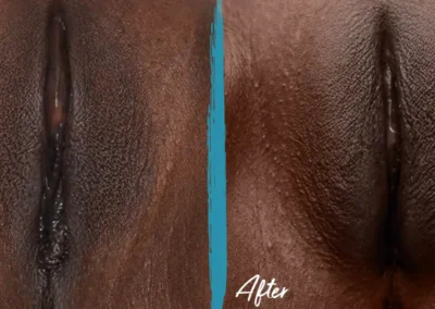 vaginal fat transfer before and after photo by mona hardas md cosmetic gynecology in flint mi