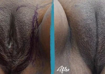 vaginal fat transfer before and after photo by mona hardas md cosmetic gynecology in flint mi