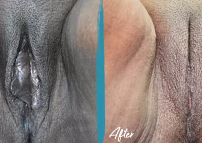 vaginal fat transfer before and after photo by mona hardas md cosmetic gynecology in flint mi