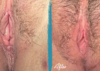 vaginal rejuvenation before and after photo by mona hardas md cosmetic gynecology in flint mi